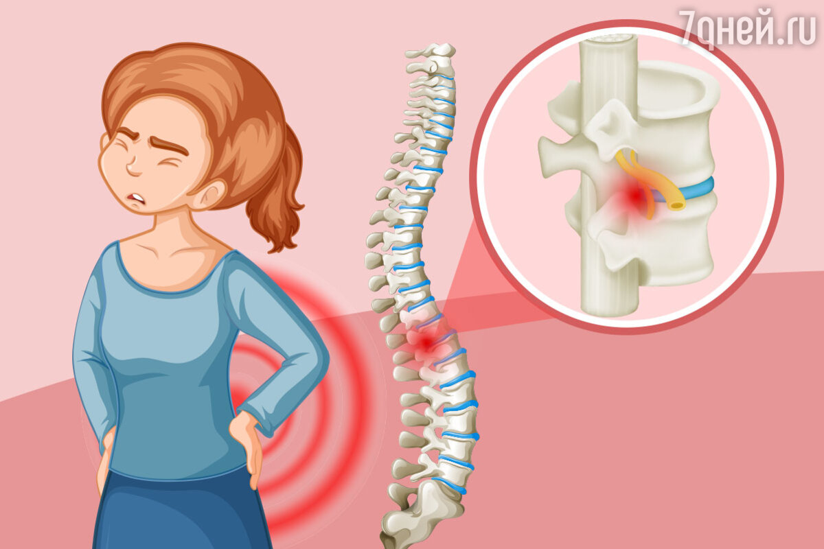 Защемило спину: причины и лечение «прострелов» - 7Дней.ру