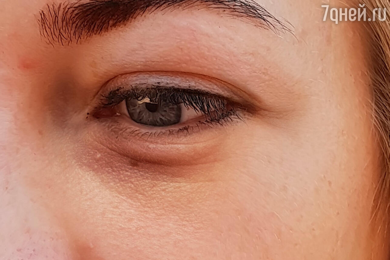 Опухшие глаза после слез: как избавиться от отеков под глазами