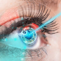 5 популярных вопросов офтальмологу о лазерной коррекции зрения