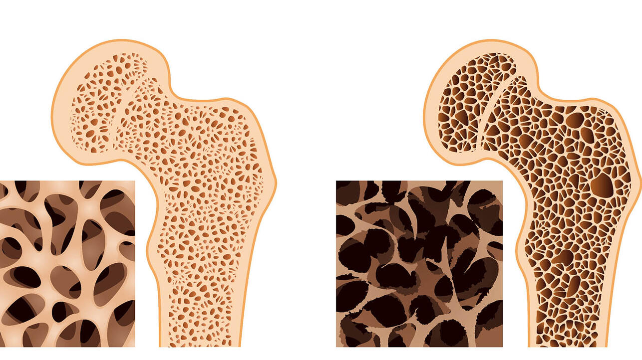 Остеопороз картинки фото