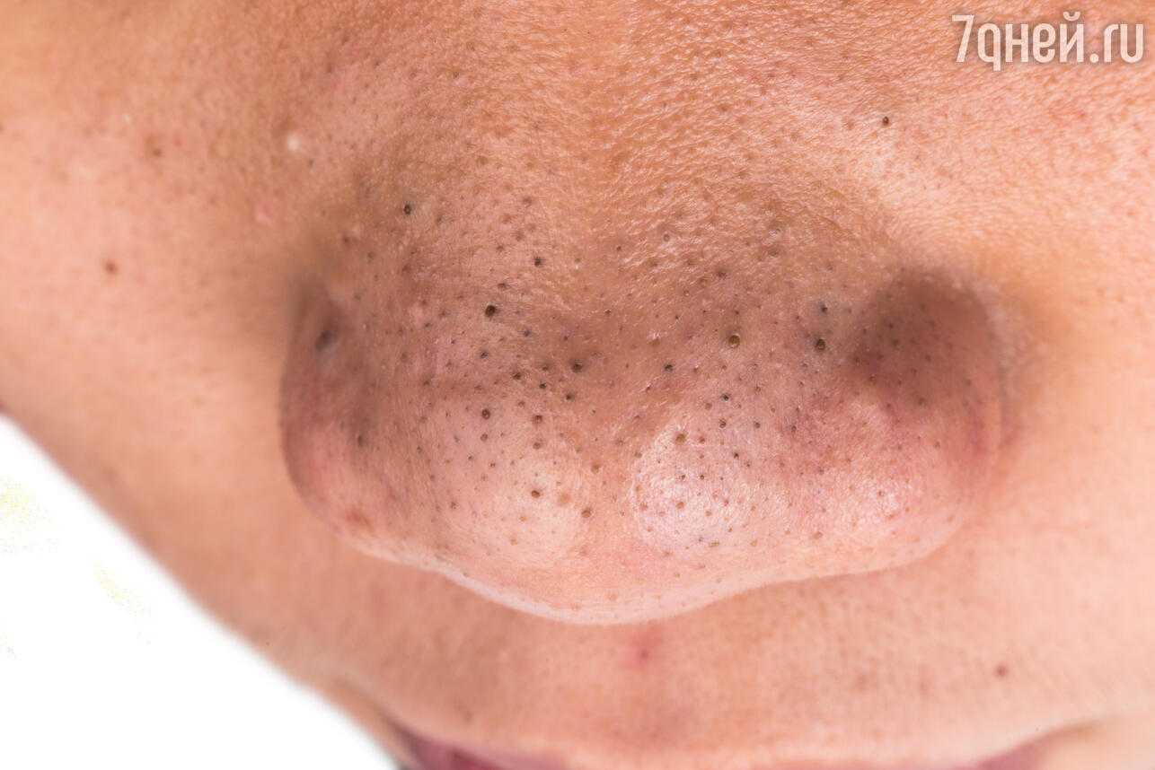 Как избавиться от черных точек на лице (комедоны): Причины, симптомы и лечение