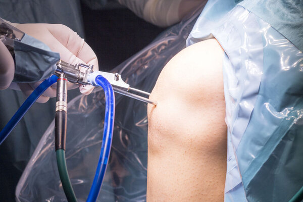 Артроскопические операции на колене: эффективны или бесполезны?