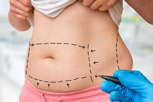 Честно о липосакции: безопасно ли откачивать жир 