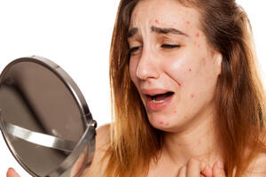 Нервные высыпания: как кожа предупреждает о проблемах с психикой 