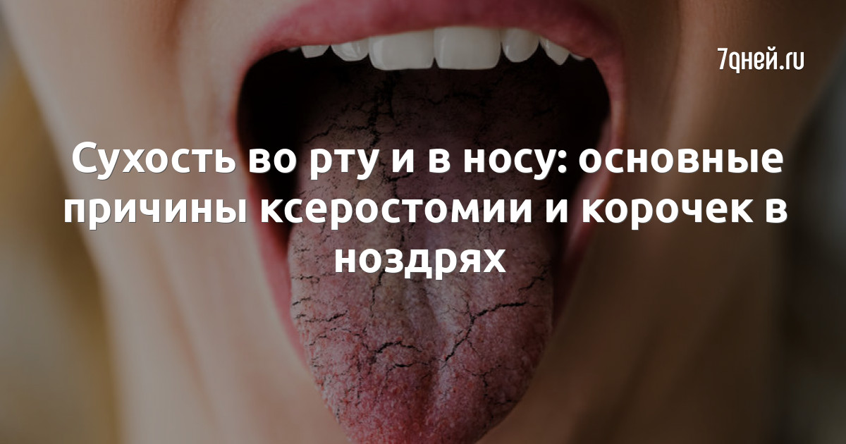 Сухость во рту и в носу: основные причины ксеростомии и корочек в ноздрях -  7Дней.ру